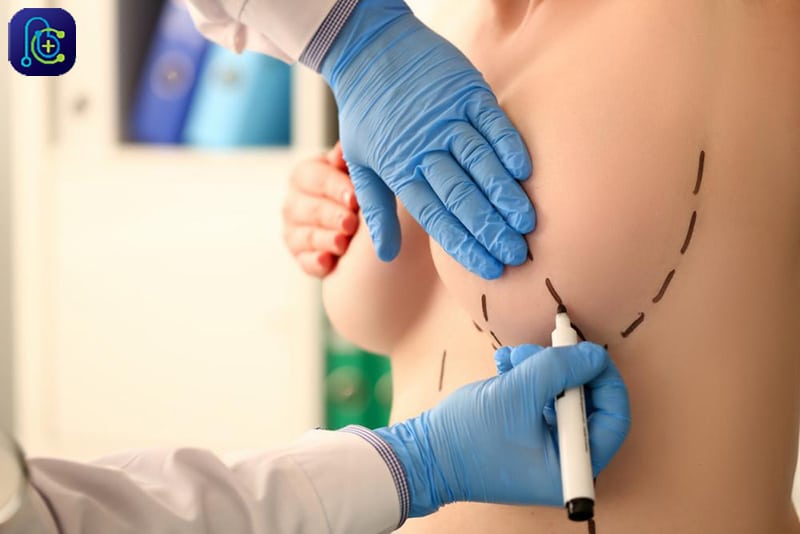مشخص کردن ناحیه جراحی برای عمل لیفت سینه