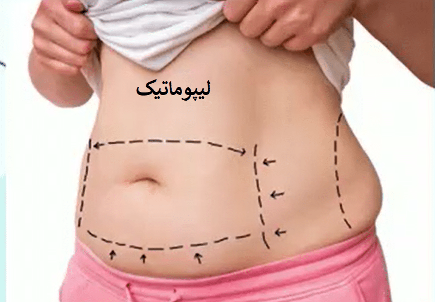 لیپوماتیک