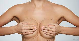 Breast prosthesis replacement.seo