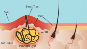 How to prevent hair cysts.seo
