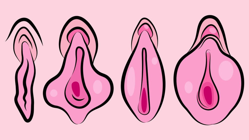 نمونه گرافیکی از انواع واژن برای عمل لابیاپلاستی