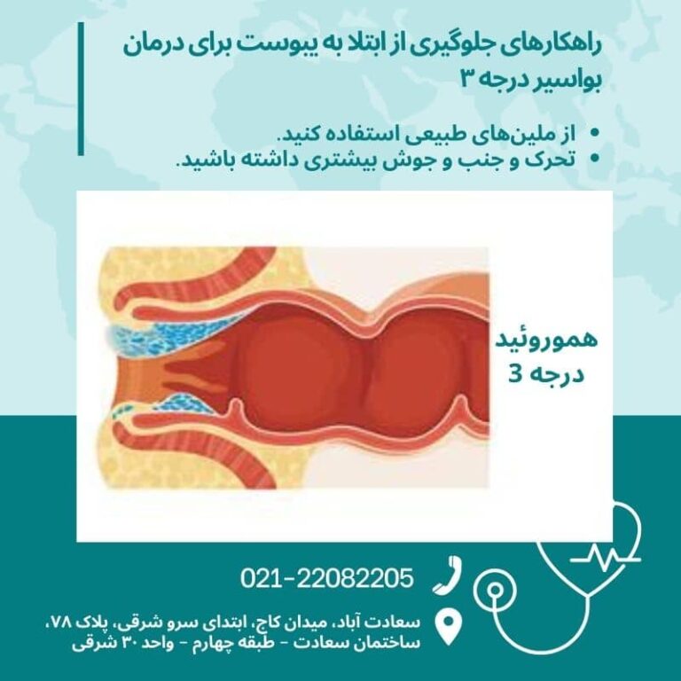 برای بیرون زدگی بواسیر چه کنیم؟