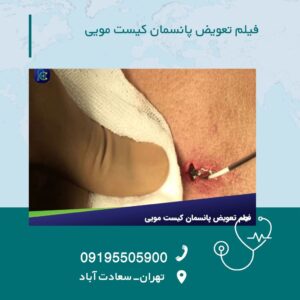 فیلم جراحی کیست مویی با بخیه
