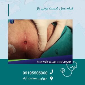 فیلم عمل کیست مویی باز چگونه است؟