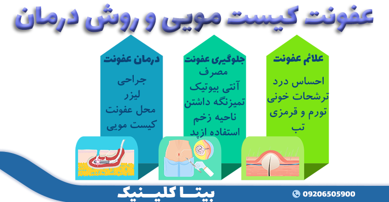 علائم و درمان عفونت کیست مویی