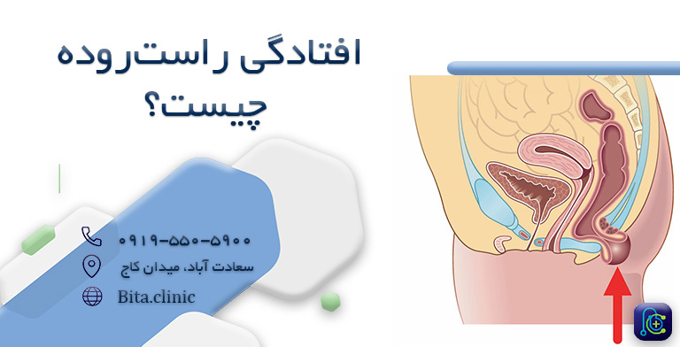 افتادگی راستروده