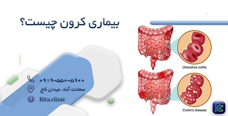 بیماری کرون چیست؟