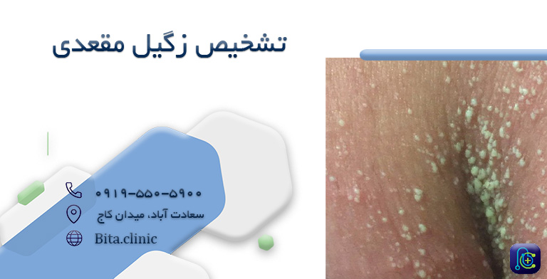 تشخیص زگیل مقعدی