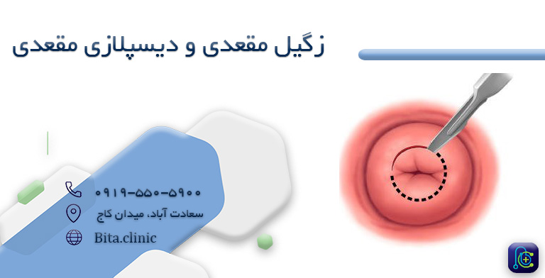زگیل مقعدی و دیسپلازی مقعدی