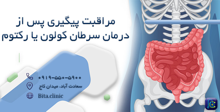 نسخه توسعه یافته مراقبت پیگیری پس از درمان سرطان کولون یا رکتوم