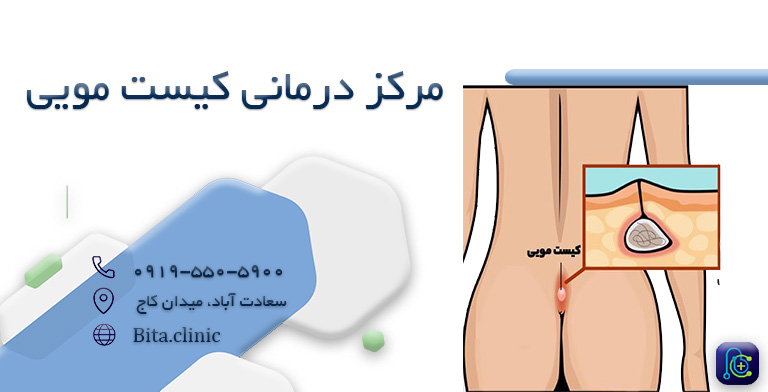 مرکز-درمانی-کیست-مویی