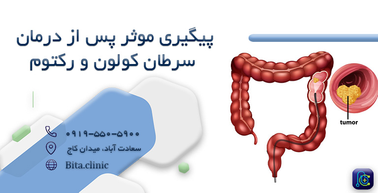 پیگیری موثر پس از درمان سرطان کولون یا رکتوم